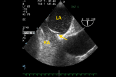 European Guidelines Represent First Intersocietal Position on Percutaneous PFO Closure